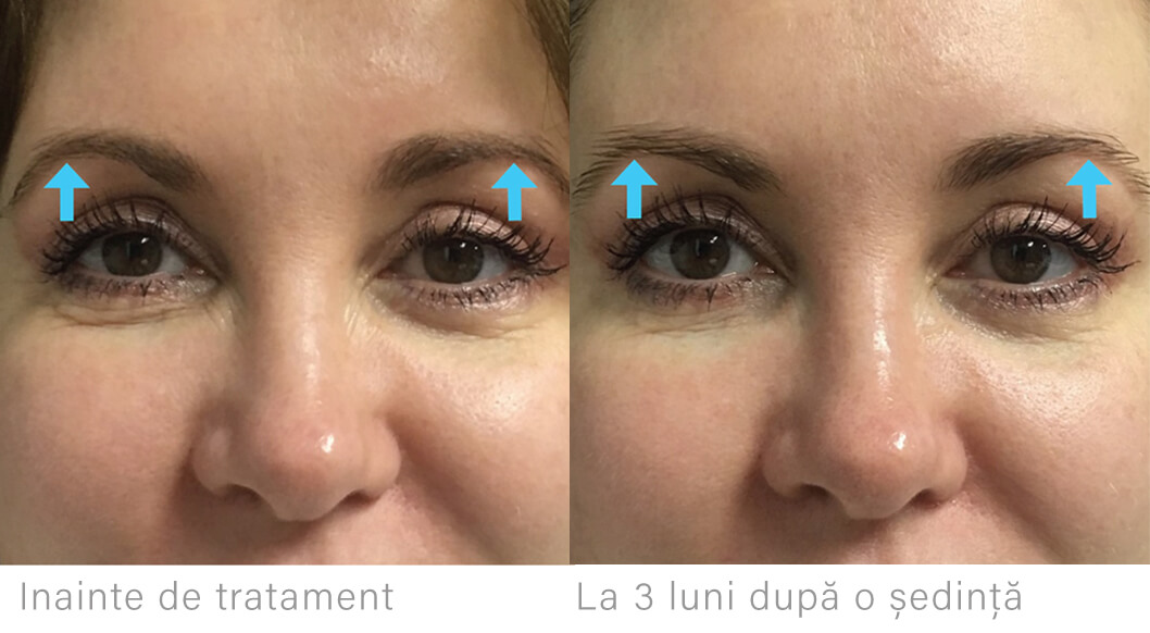 i.php?p=Liftera-sprancene (1).jpg