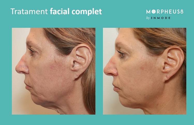 rezultate morpheus 8 facial