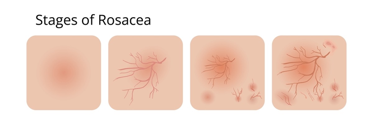 etapelor de evolutie a cuperozei etapelor de evolutie a cuperozei